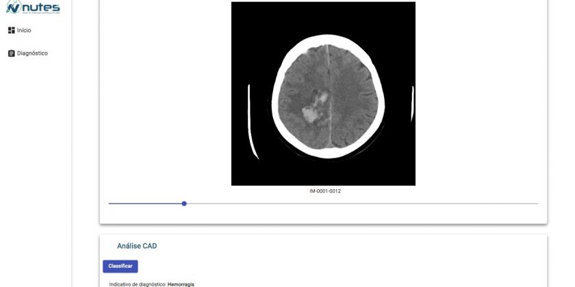 Laboratório de Imagens e Sinais do Nutes desenvolve software para classificação de tipos de AVC